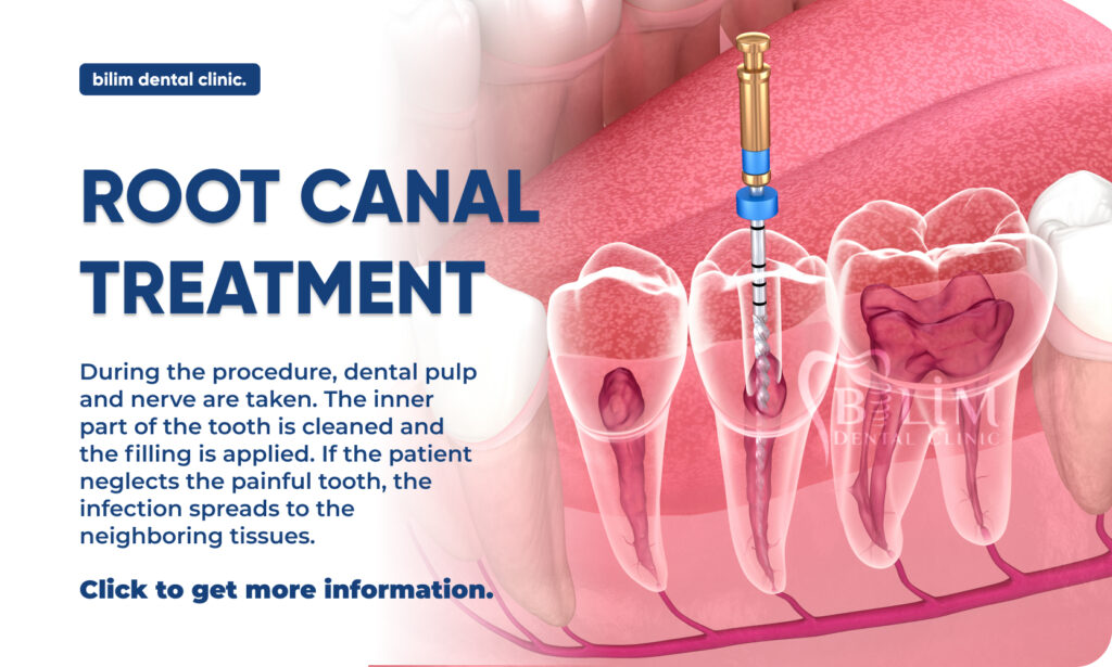 Root Canal Treatment - Bilim Diş Kliniği