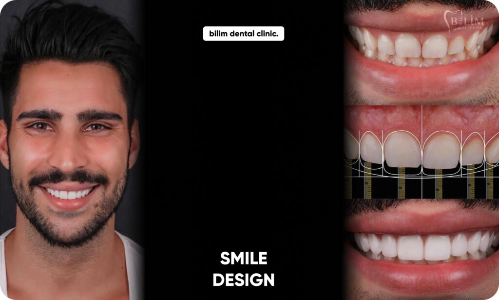 Smile Design – Bilim Diş Kliniği