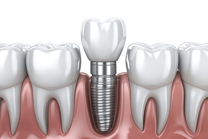 Diş İmplantı Maliyeti - Maltepe Bilim Diş Kliniği