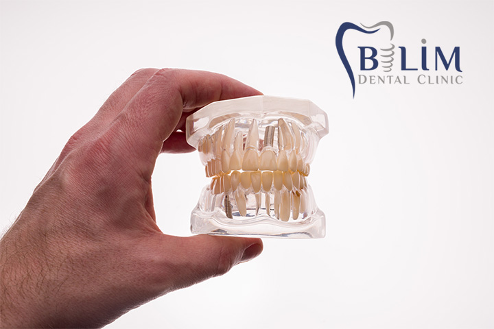 Geçici dişler, diş kaybı yaşayan bireyler için kalıcı protezler yapılana kadar kullanılan, estetik ve fonksiyonelliği geçici olarak sağlayan yapay dişlerdir.