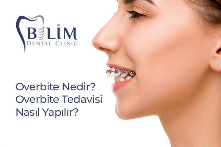 Ortodontik bir sorun olarak değerlendirilen overbite, estetik kaygılara neden olabilir. Hem çene eklemi ve diş sağlığı üzerinde olumsuz etki yapabilir.