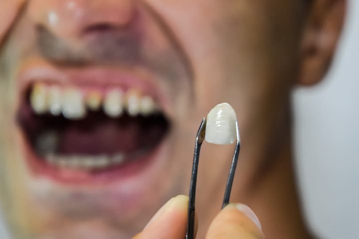 Diş Kaplamam Kırıldı, Ne yapmalıyım? - Maltepe Bilim Diş Kliniği