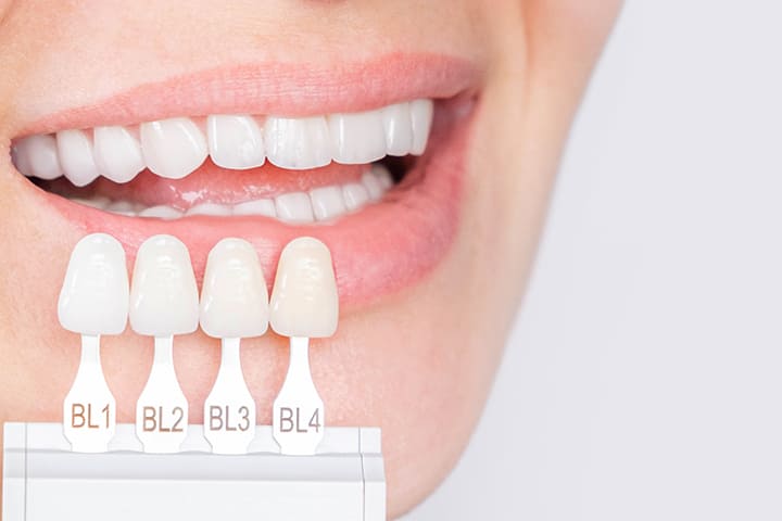 Emax Diş Kaplama Uzun Ömürlü Müdür? - Maltepe Bilim Diş Kliniği