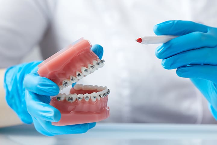 Ortodontik Tedavi Sırasında Nelere Dikkat Edilmelidir? - Maltepe Bilim Diş Kliniği