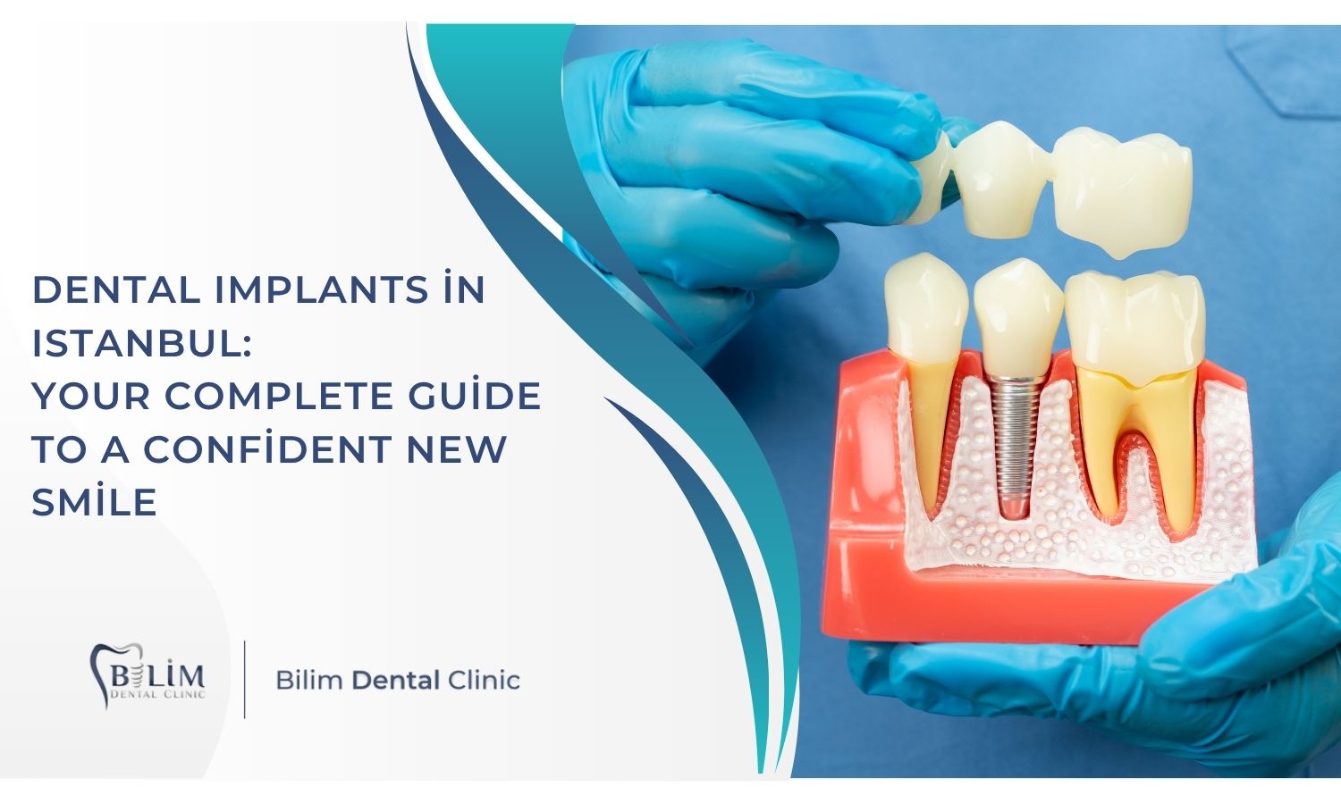Dental Implants in Istanbul: Your Complete Guide to a Confident New Smile