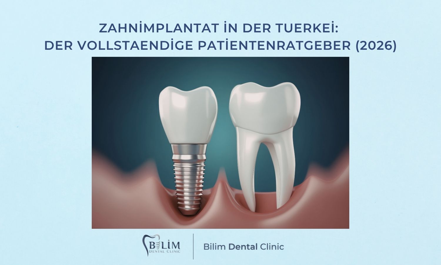 Zahnimplantat in der Tuerkei: Der vollstaendige Patientenratgeber (2026)