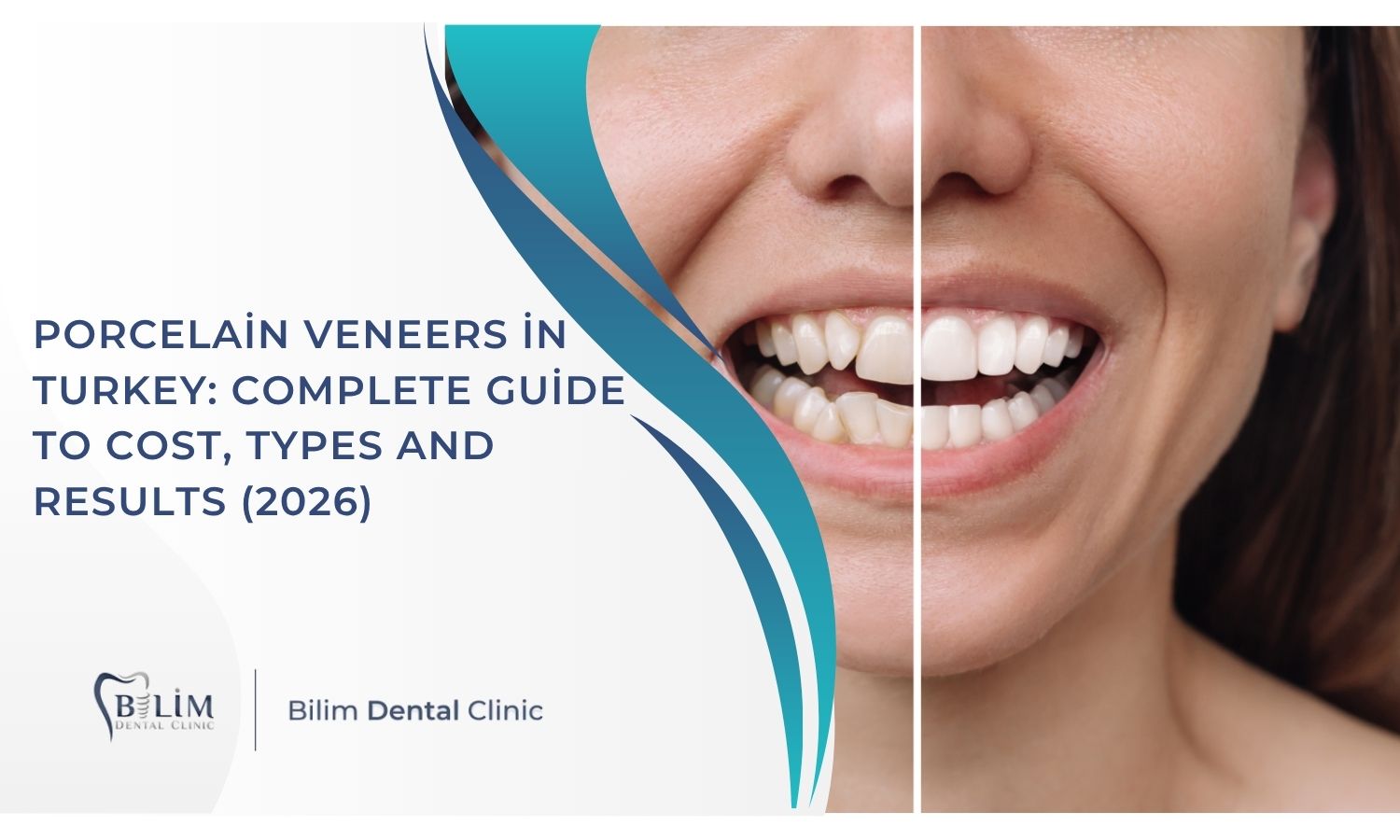 Porcelain Veneers in Turkey: Complete Guide to Cost, Types and Results (2026)