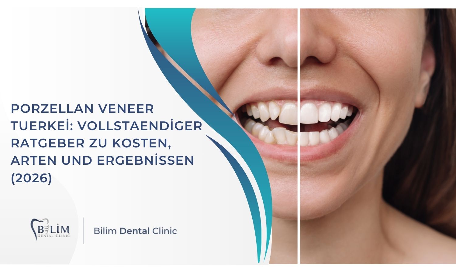 Porzellan Veneer Tuerkei: Vollstaendiger Ratgeber zu Kosten, Arten und Ergebnissen (2026)
