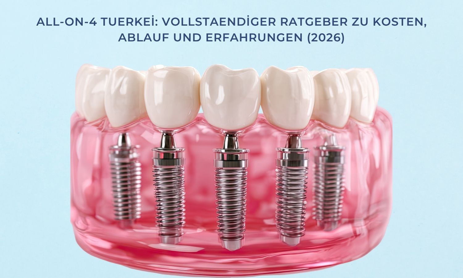 All-on-4 Tuerkei: Vollstaendiger Ratgeber zu Kosten, Ablauf und Erfahrungen (2026)