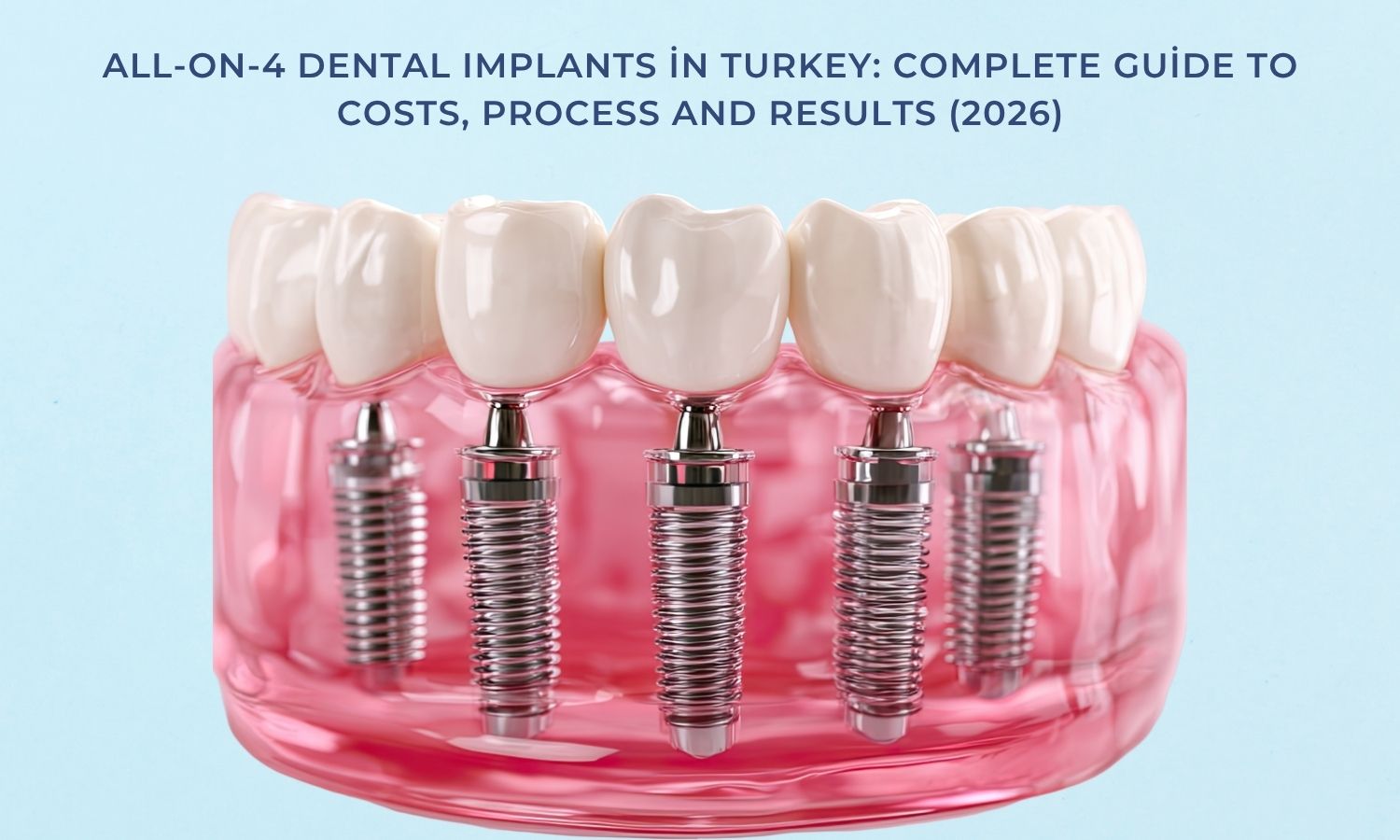All-on-4 Dental Implants in Turkey: Complete Guide to Costs, Process and Results (2026)