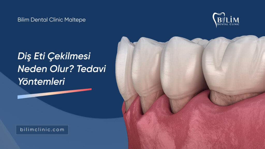 diş eti çekilmesi