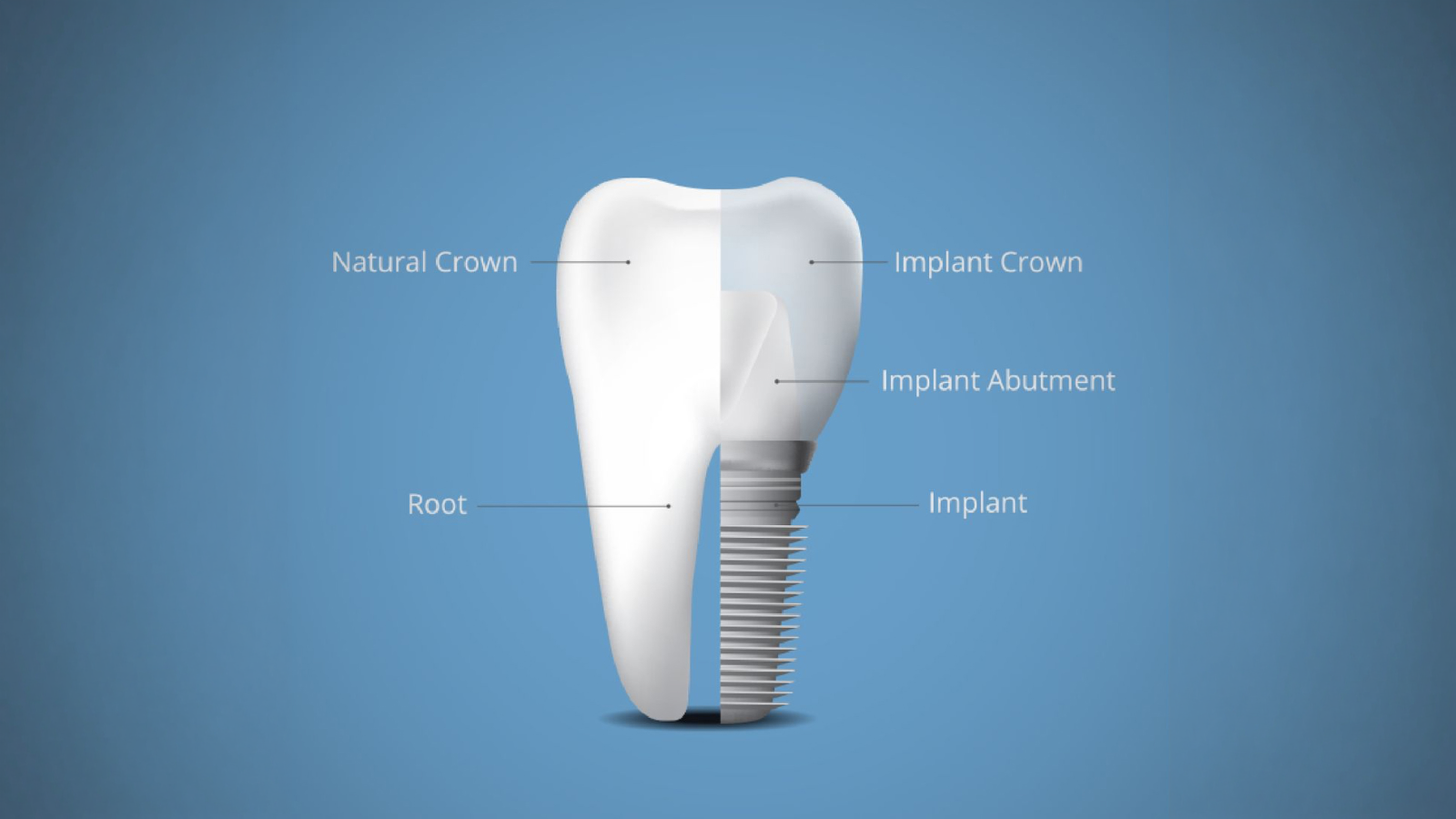 Peri-implantitis