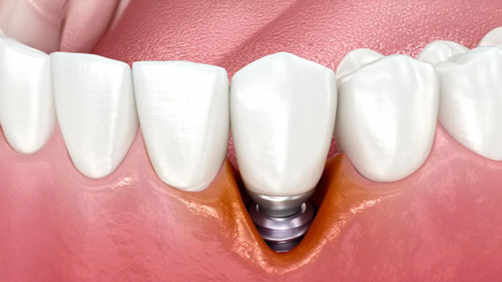 Peri-implantitis