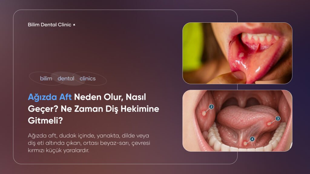 ağızda aft