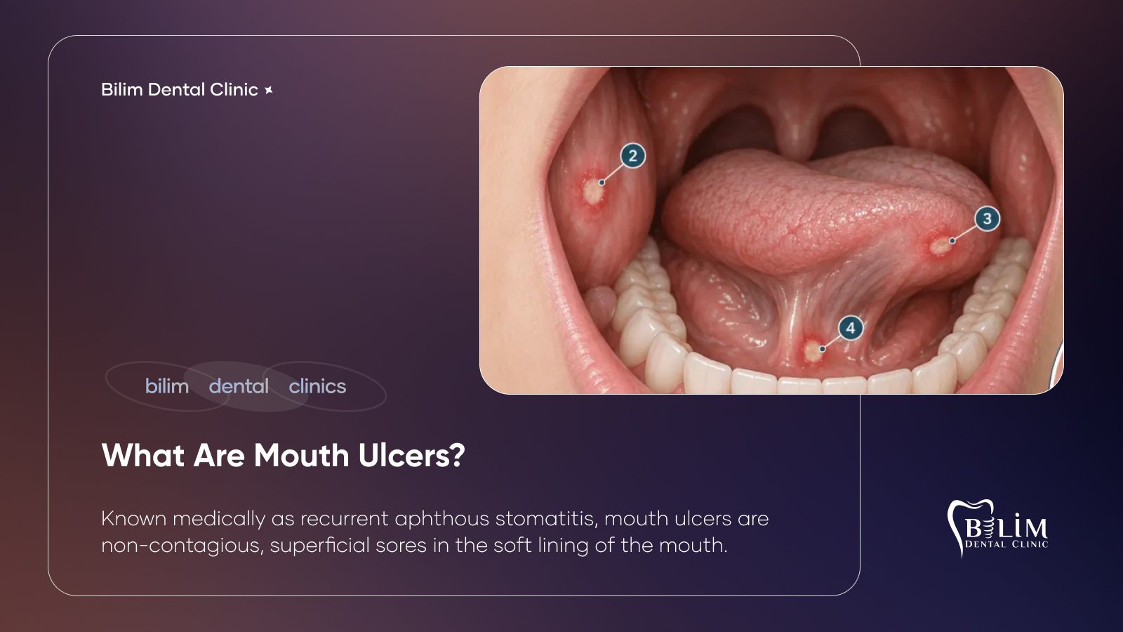 mouth ulcers