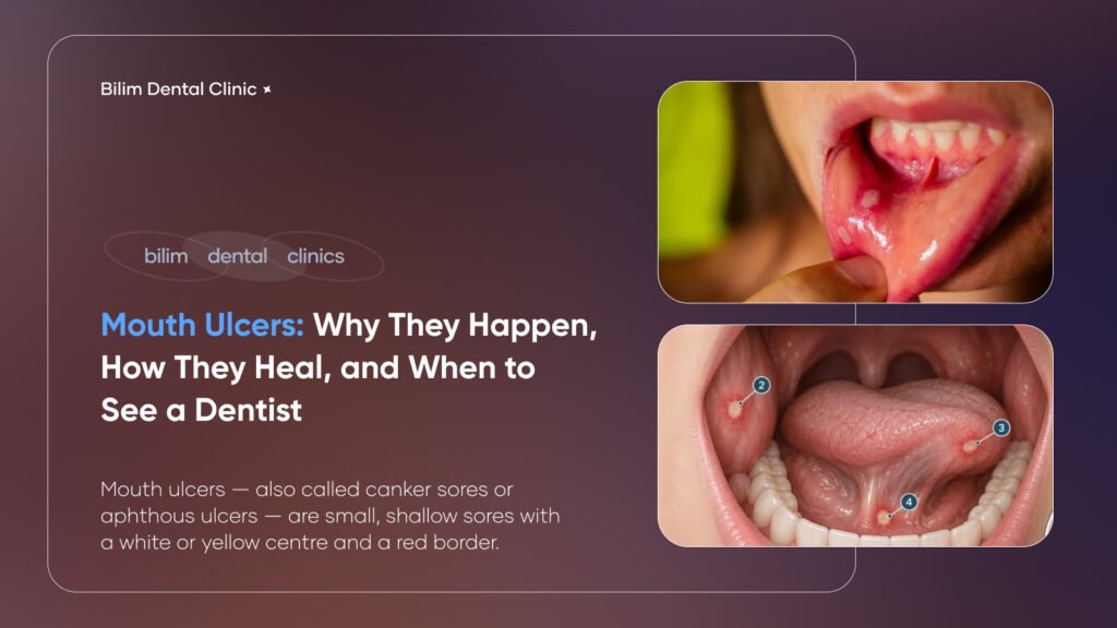 mouth ulcers