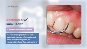 diastema