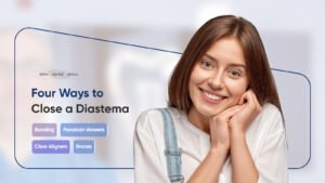 diastema