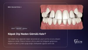 gömülü köpek dişi