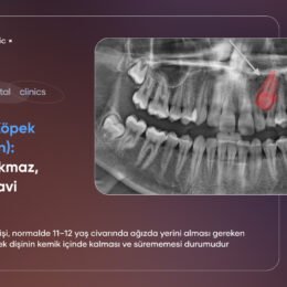gömülü köpek dişi