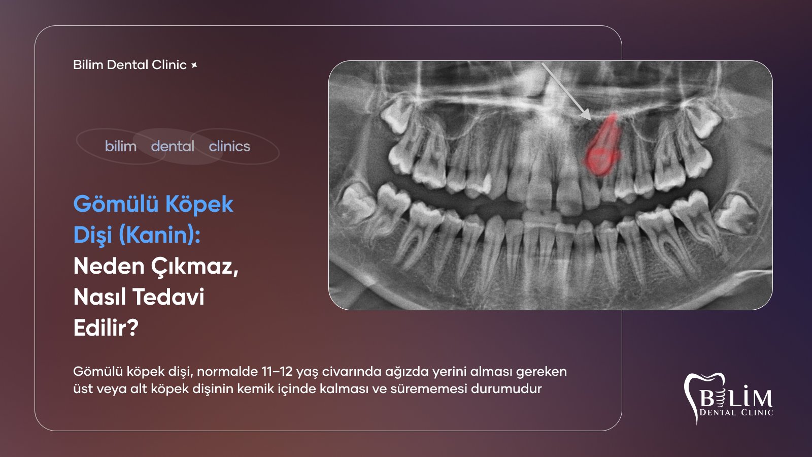 gömülü köpek dişi