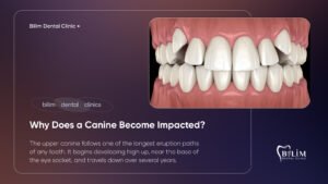 impacted canine