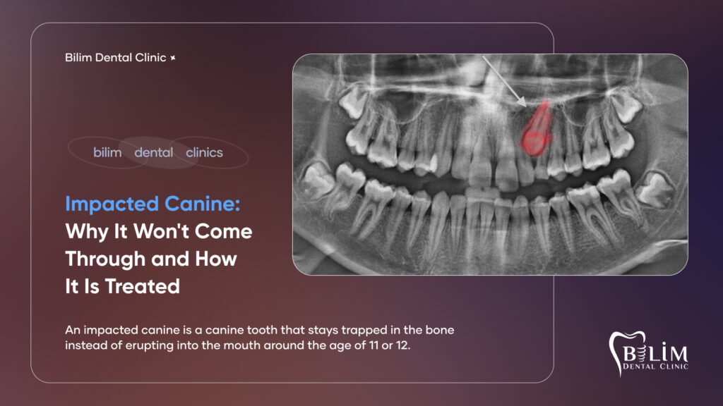 impacted canine