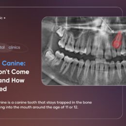 impacted canine