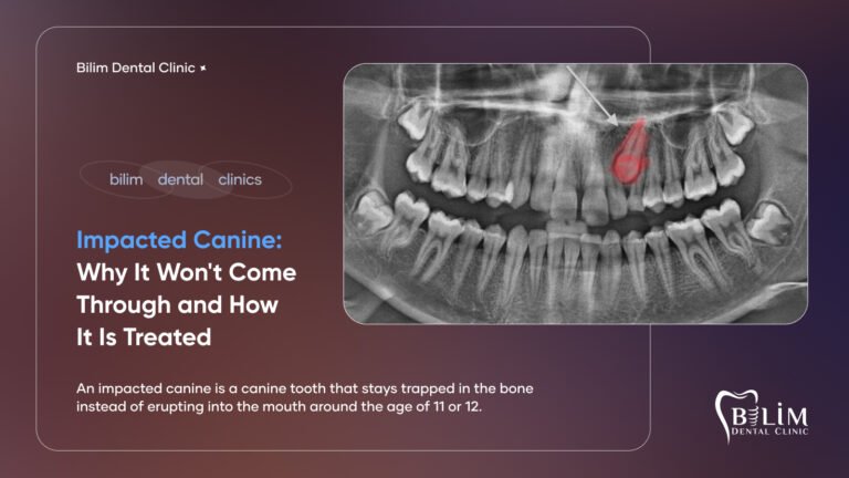 impacted canine